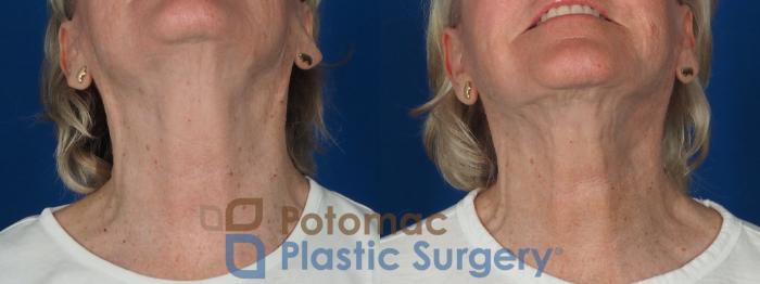 Before & After Neck Lift Case 279 Bottom View in Washington, DC