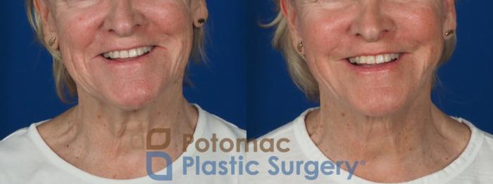 Before & After Neck Lift Case 279 Front - Smiling View in Washington, DC
