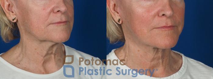 Before & After Neck Lift Case 279 Right Oblique View in Washington, DC