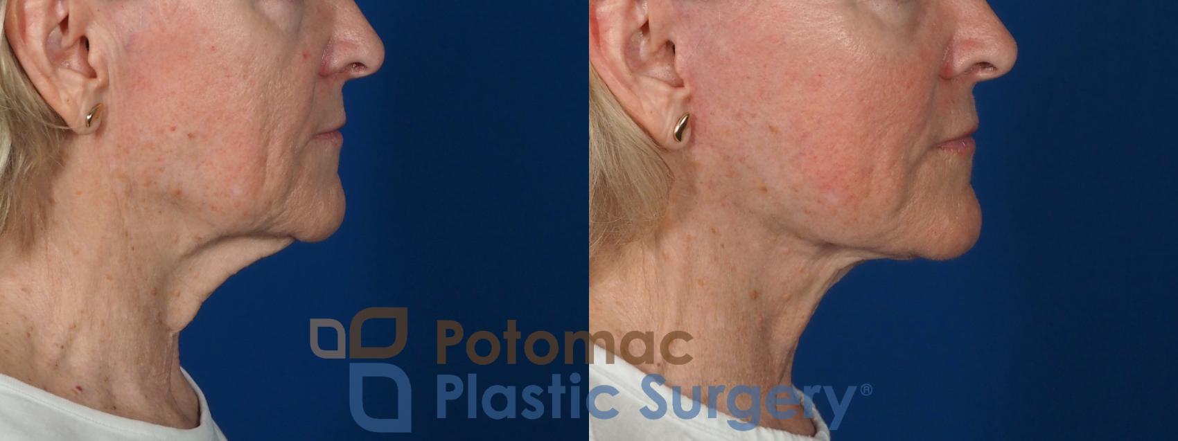 Before & After Neck Lift Case 279 Right Side View in Washington, DC