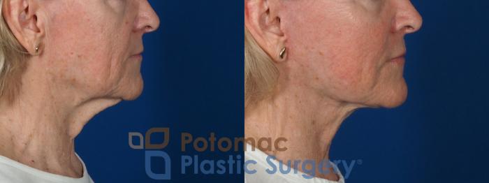 Before & After Facelift Case 279 Right Side View in Washington, DC