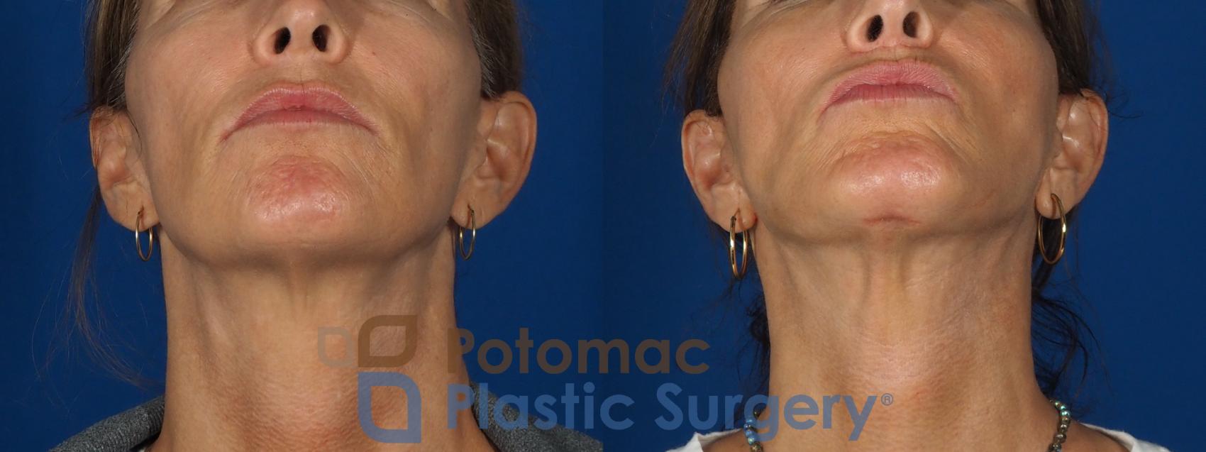 Before & After Facelift Case 295 Bottom View in Washington, DC