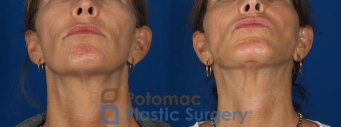 Before & After Facelift Case 295 Bottom View in Washington, DC