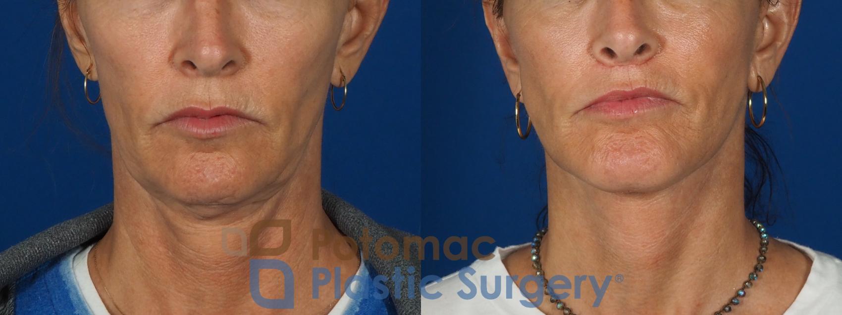 Before & After Neck Lift Case 295 Front View in Washington, DC