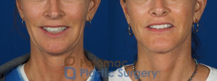 Before & After Facelift Case 295 Front - Smiling View in Washington, DC