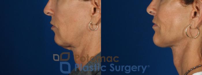 Before & After Facelift Case 295 Left Side View in Washington, DC