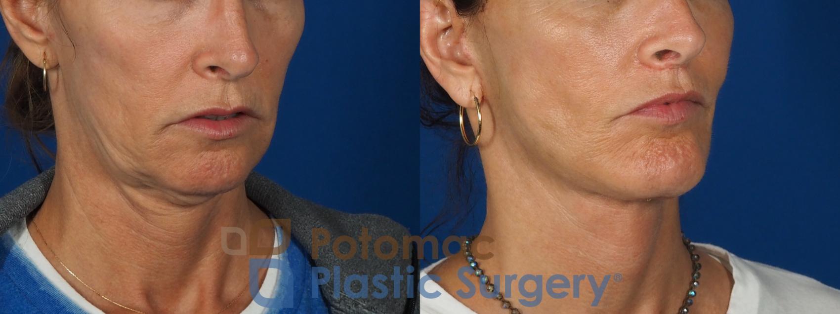 Before & After Facelift Case 295 Right Oblique View in Washington, DC