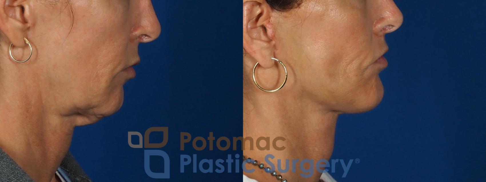 Before & After Facelift Case 295 Right Side View in Washington, DC