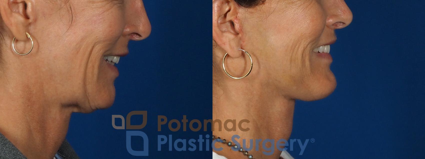 Before & After Facelift Case 295 Right - Smiling View in Washington, DC