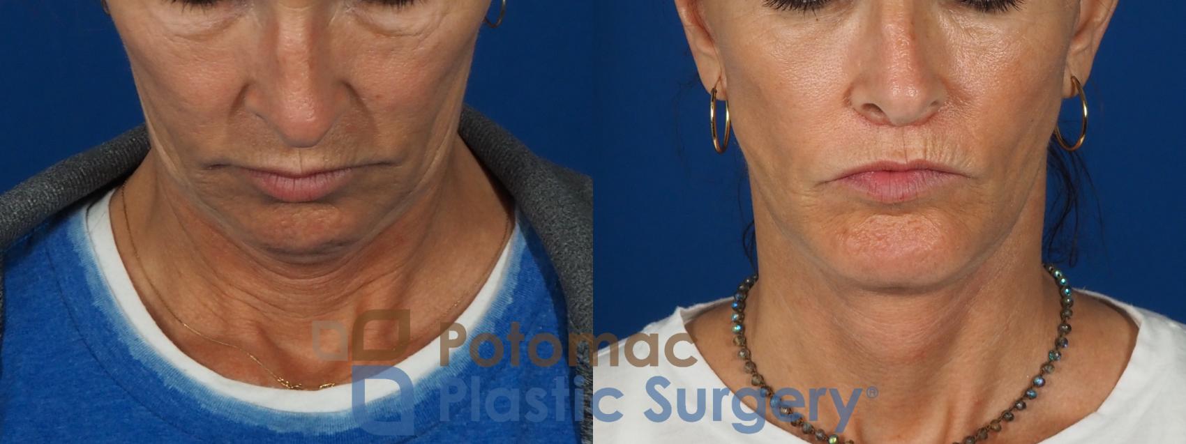 Before & After Facelift Case 295 Top View in Washington, DC