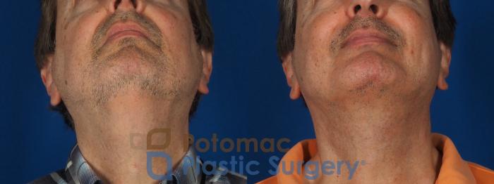 Before & After Chin Augmentation Case 302 Bottom View in Washington DC & Arlington , DC