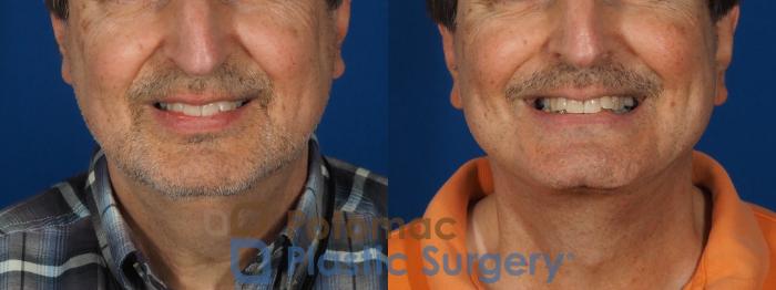 Before & After Liposuction Case 302 Front - Smiling View in Washington DC & Arlington , DC
