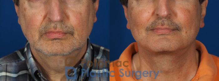Before & After Cheek Augmentation Case 302 Front View in Washington DC & Arlington , DC