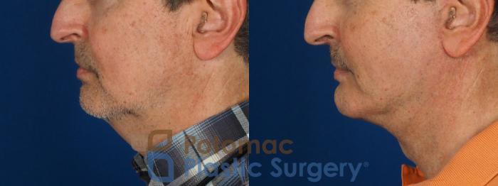 Before & After Liposuction Case 302 Left Side View in Washington DC & Arlington , DC