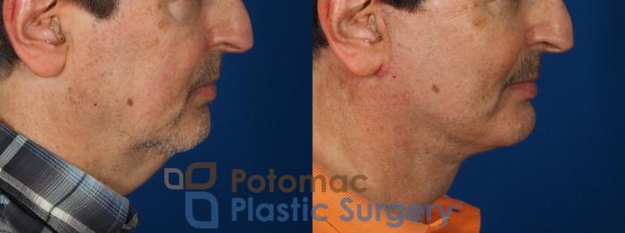 Before & After Facial Sculpting Case 302 Right Side View in Washington DC & Arlington , DC