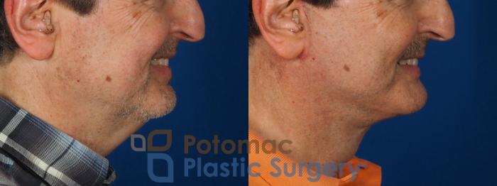 Before & After Facial Sculpting Case 302 Right - Smiling View in Washington DC & Arlington , DC