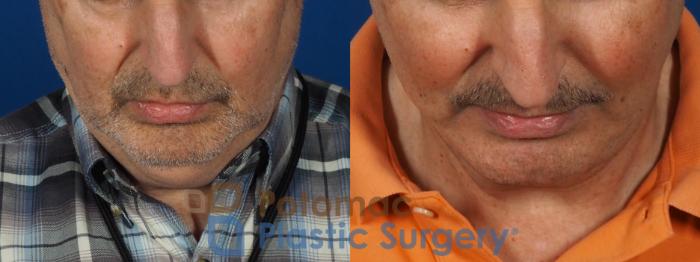 Before & After Facial Sculpting Case 302 Top View in Washington DC & Arlington , DC