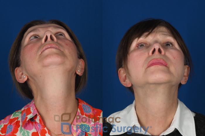 Before & After Chin Augmentation Case 331 Bottom View in Washington DC & Arlington , DC