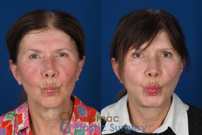 Before & After Facial Sculpting Case 331 Front - Puckering View in Washington DC & Arlington , DC