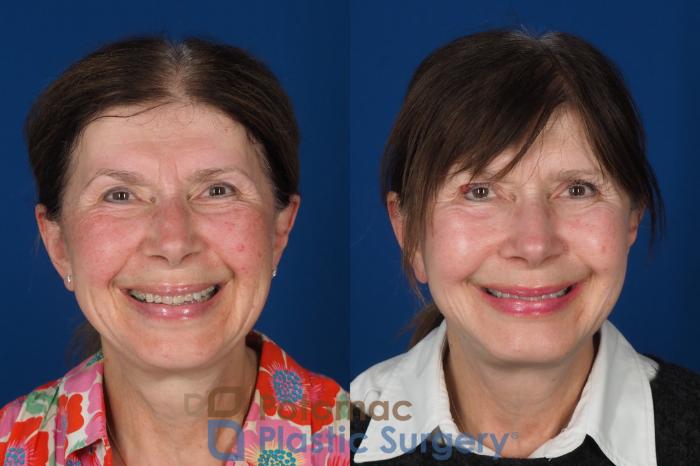 Before & After Chin Augmentation Case 331 Front - Smiling View in Washington DC & Arlington , DC