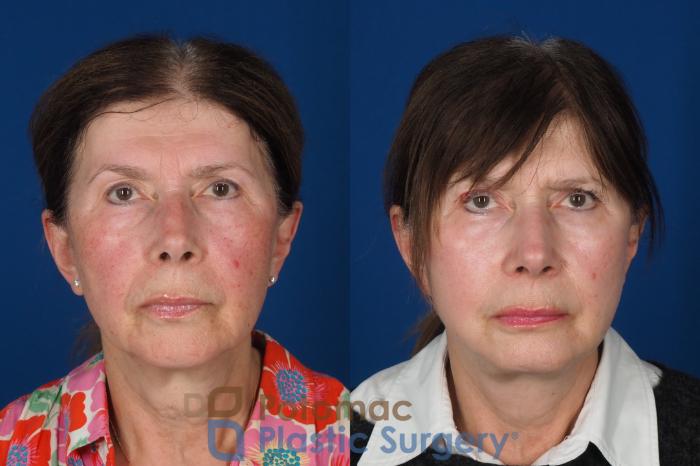 Before & After Skin Care Case 331 Front View in Washington DC & Arlington , DC