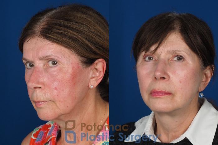 Before & After Facial Sculpting Case 331 Left Oblique 2 View in Washington DC & Arlington , DC