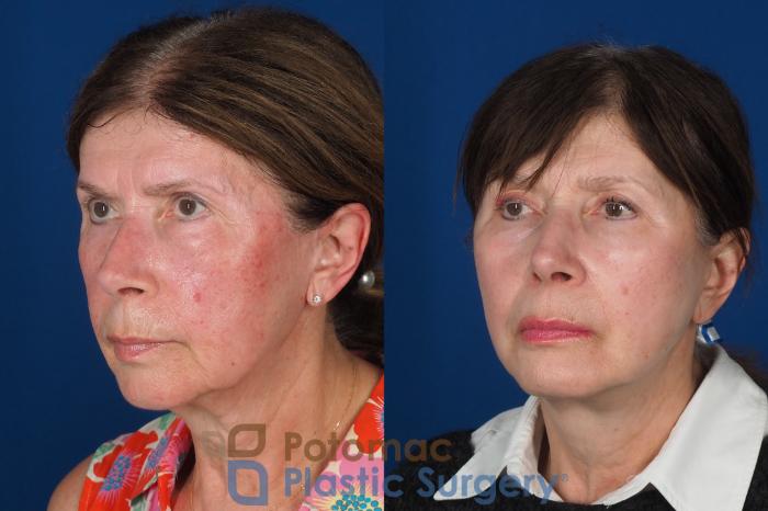 Before & After Skin Care Case 331 Left Oblique View in Washington DC & Arlington , DC