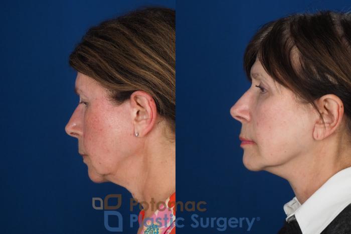 Before & After Skin Care Case 331 Left Side View in Washington DC & Arlington , DC