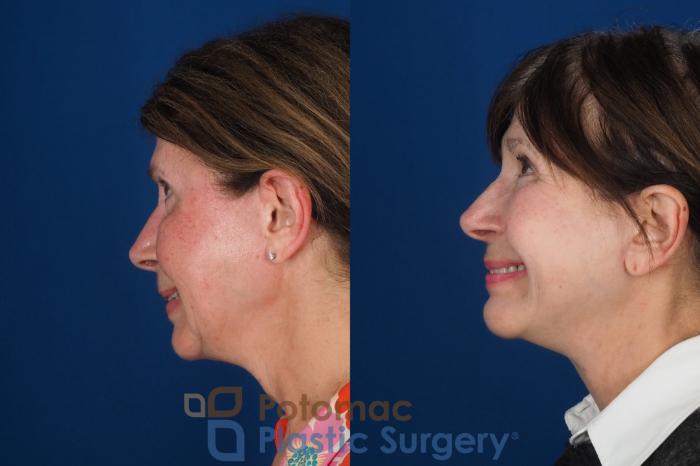 Before & After Neck Lift Case 331 Left - Smiling View in Washington DC & Arlington , DC