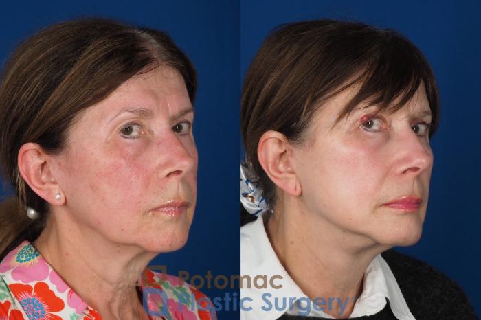 Before & After Facelift Case 331 Right Oblique 2 View in Washington DC & Arlington , DC