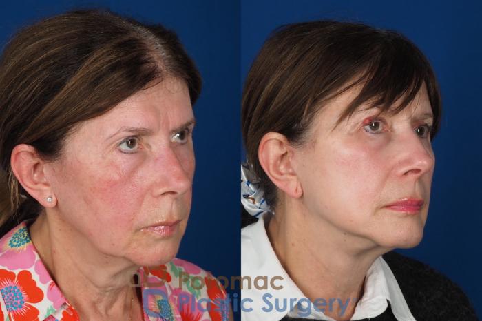 Before & After Lip Augmentation Case 331 Right Oblique View in Washington DC & Arlington , DC