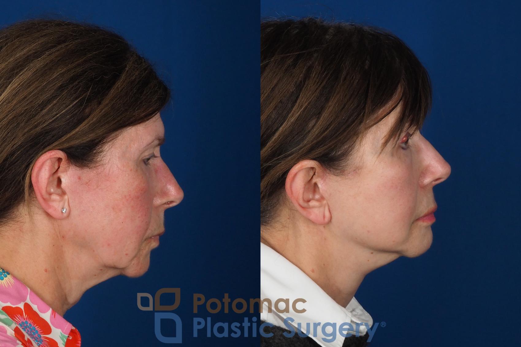 Before & After Facial Sculpting Case 331 Right Side View in Washington DC & Arlington , DC