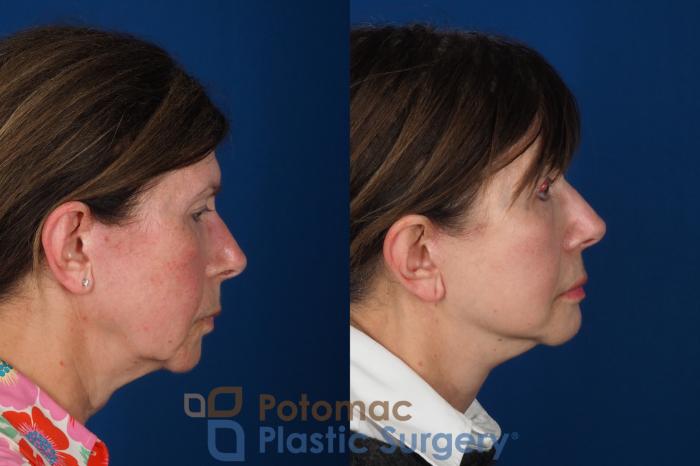 Before & After Facelift Case 331 Right Side View in Washington DC & Arlington , DC