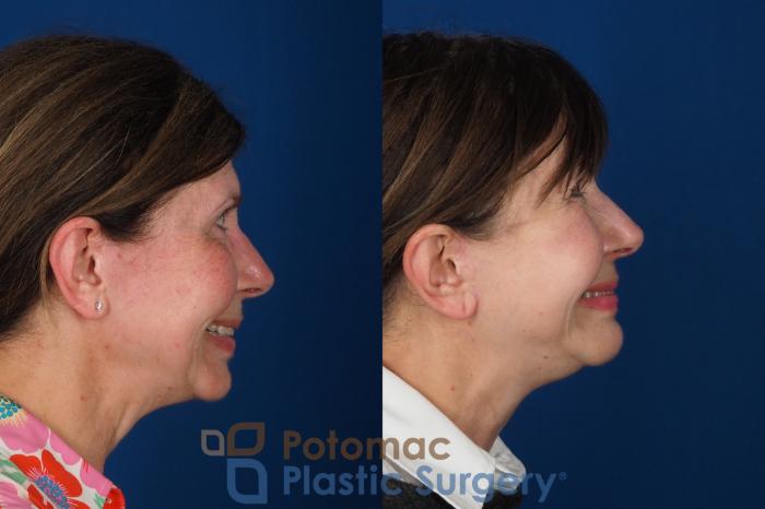 Before & After Lip Augmentation Case 331 Right - Smiling View in Washington DC & Arlington , DC