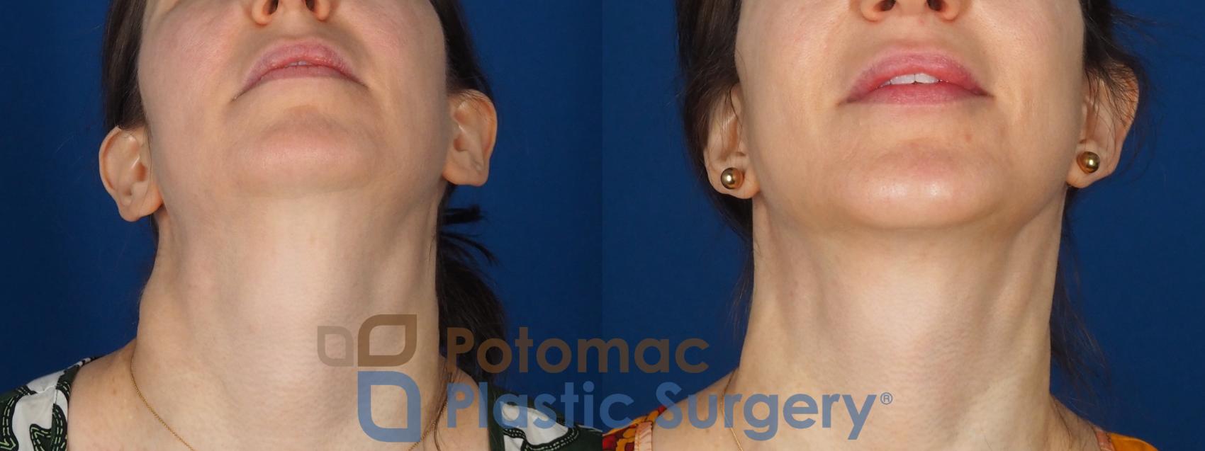 Before & After Facelift Case 346 Bottom View in Washington DC & Arlington , DC