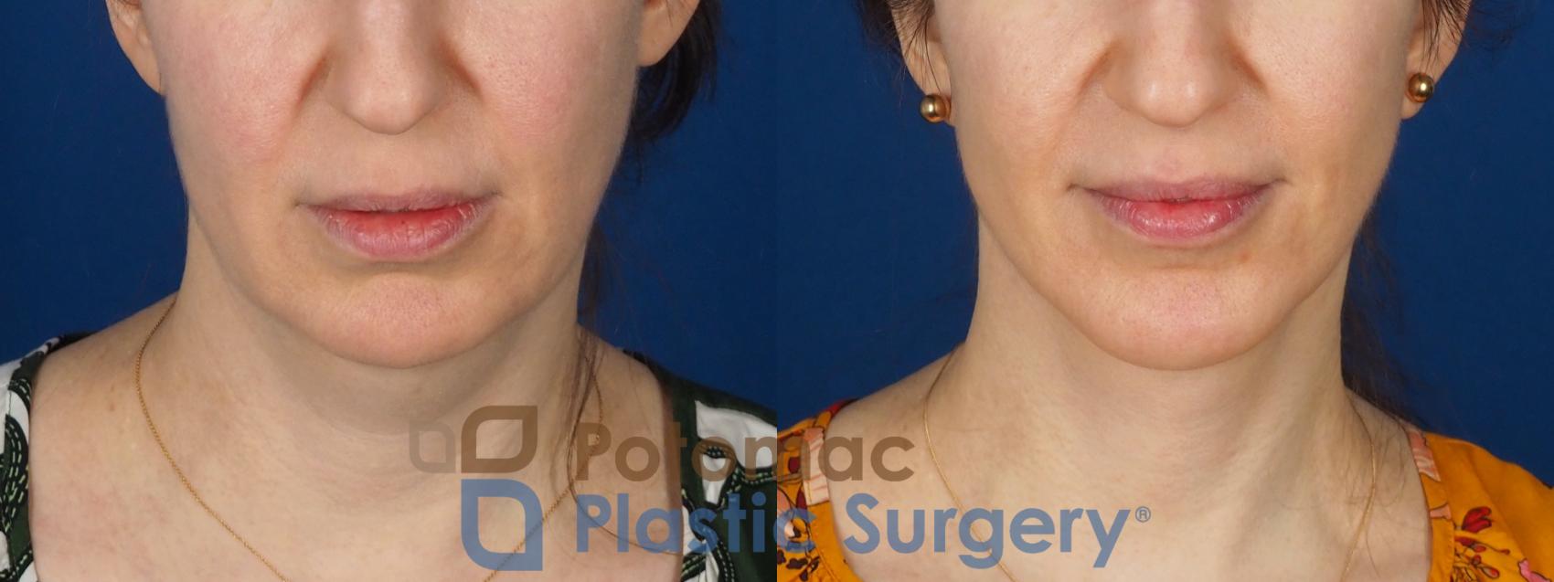 Before & After Facelift Case 346 Front View in Washington DC & Arlington , DC