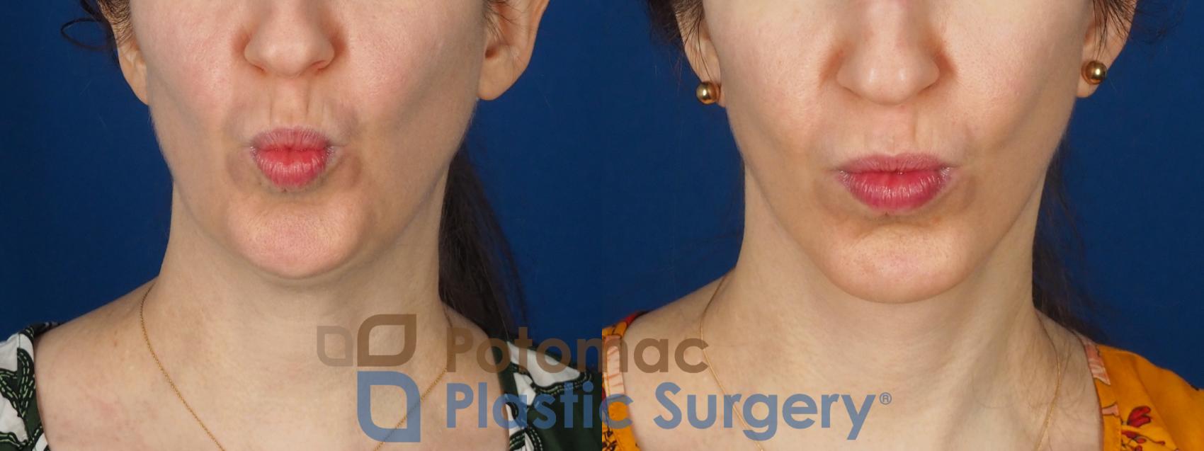 Before & After Facelift Case 346 Front - Puckering View in Washington DC & Arlington , DC