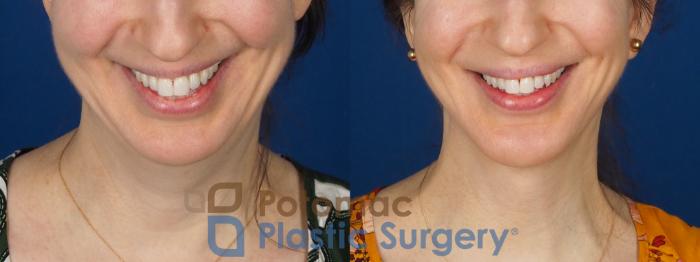 Before & After Facelift Case 346 Front - Smiling View in Washington DC & Arlington , DC