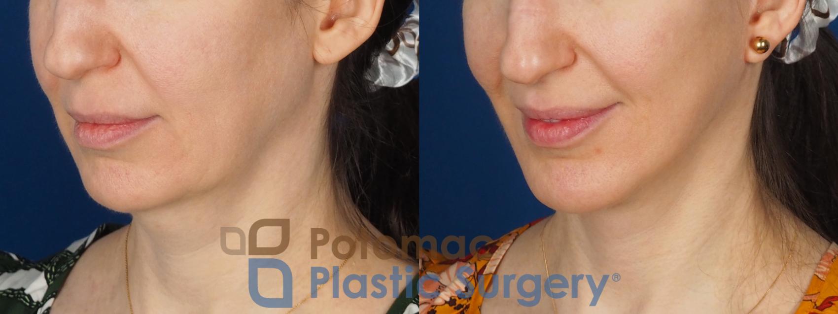Before & After Facelift Case 346 Left Oblique View in Washington DC & Arlington , DC