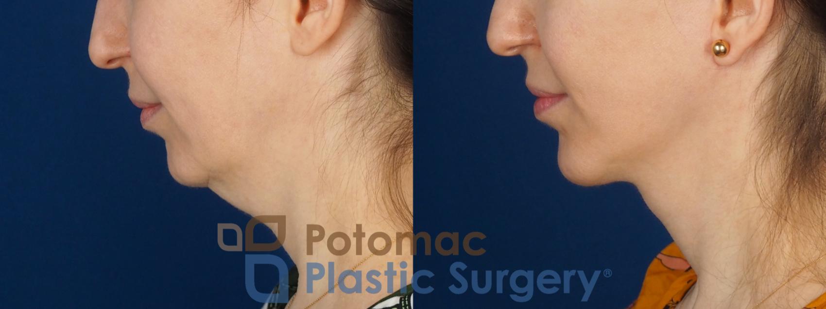 Before & After Facelift Case 346 Left Side View in Washington DC & Arlington , DC