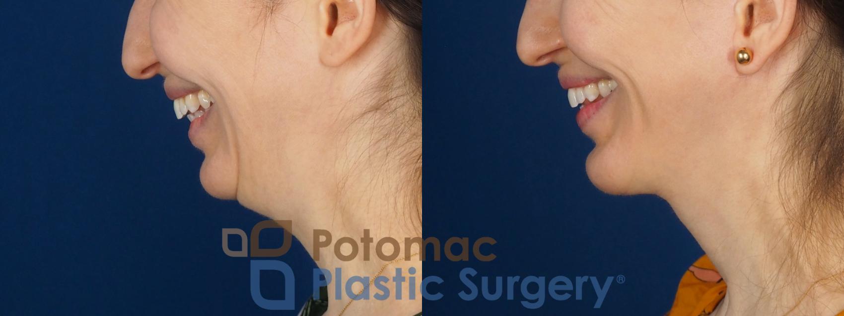 Before & After Facelift Case 346 Left - Smiling View in Washington DC & Arlington , DC