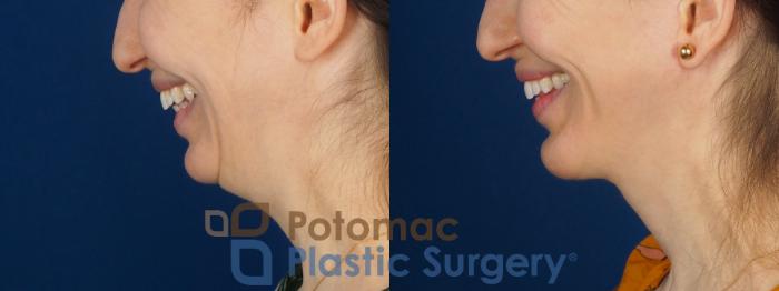 Before & After Facelift Case 346 Left - Smiling View in Washington DC & Arlington , DC