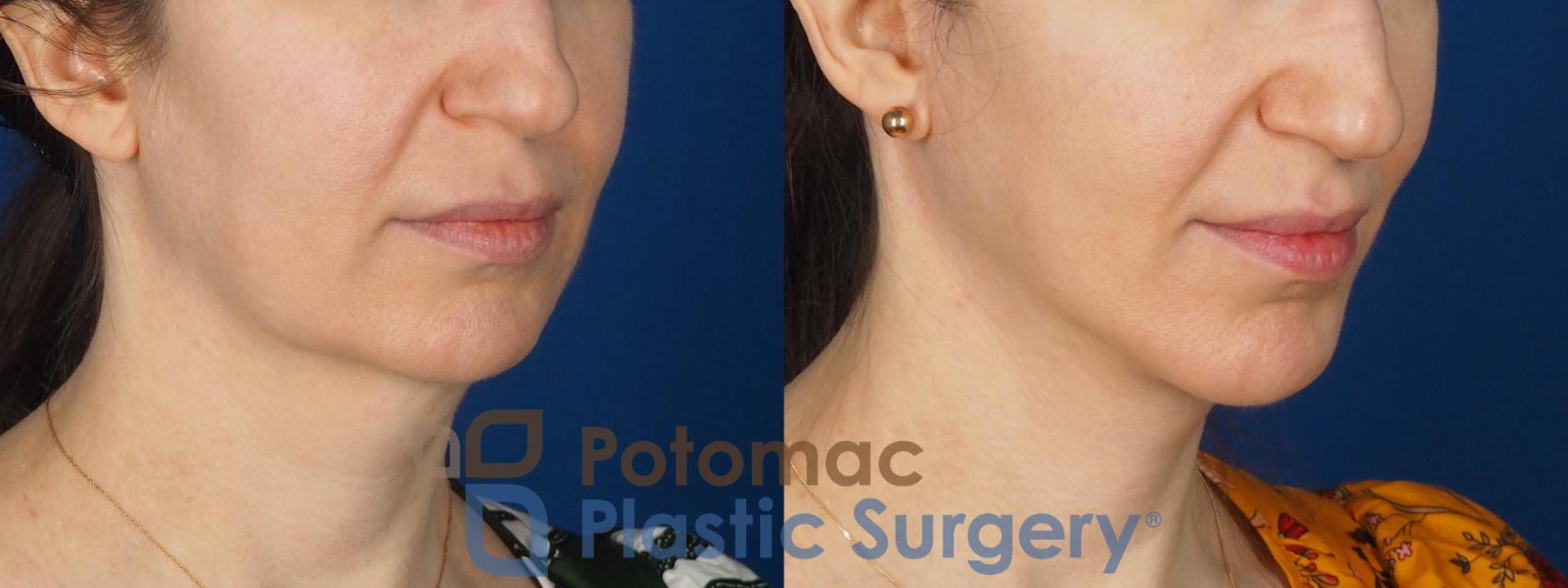 Before & After Facelift Case 346 Right Oblique View in Washington DC & Arlington , DC