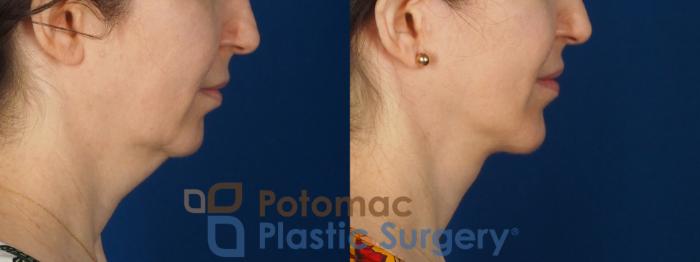 Before & After Facelift Case 346 Right Side View in Washington DC & Arlington , DC