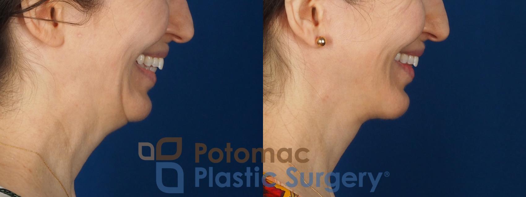 Before & After Facelift Case 346 Right - Smiling View in Washington DC & Arlington , DC