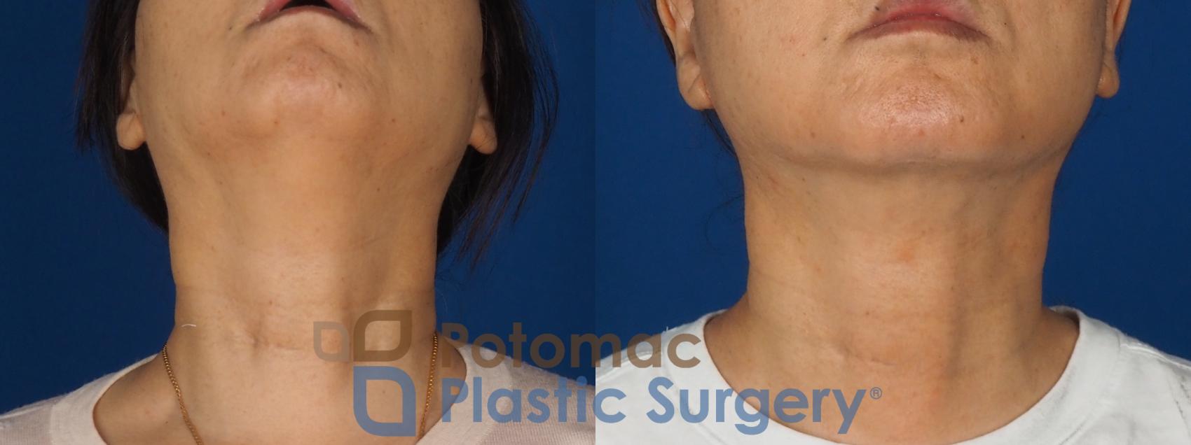 Before & After Facelift Case 350 Bottom View in Washington DC & Arlington , DC