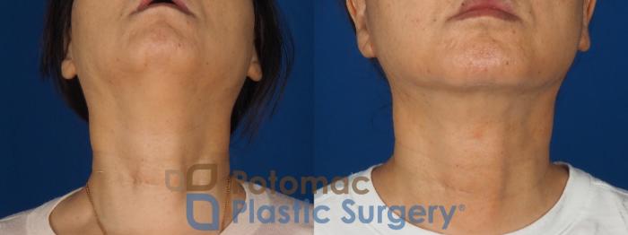 Before & After Neck Lift Case 350 Bottom View in Washington DC & Arlington , DC