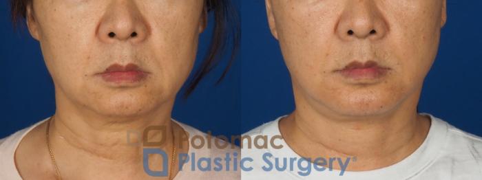 Before & After Neck Lift Case 350 Front View in Washington DC & Arlington , DC