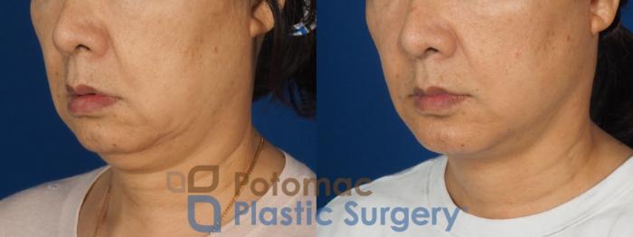 Before & After Neck Lift Case 350 Left Oblique View in Washington DC & Arlington , DC
