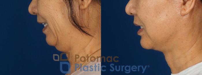 Before & After Neck Lift Case 350 Left Side View in Washington DC & Arlington , DC